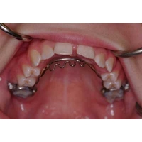 10 Best Practices For composite fillings Blue Springs